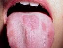 Как определить болезни языка человека: фото, симптомы