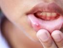 Слюнные железы, иммунная защита полости рта Защиту слизистой оболочки полости рта обеспечивает