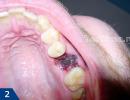 После удаления зуба болит десна: что делать